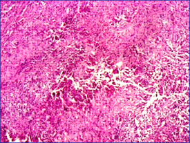 Ndulos tumorales con clulas eosinoflicas epitelioides o rabdoides y reas centrales de necrosis