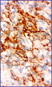 El inmunomarcaje en las membranas de las clulas epitelioides se destaca con el anticuerpo CD34