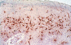 Clulas dendrticas en una lesin de leishmaniasis cutanea localizada